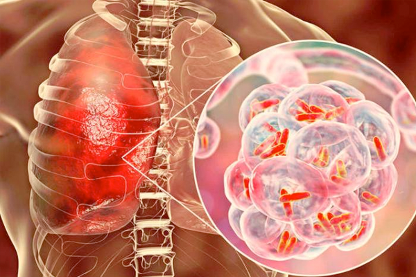 La tuberculosis aún existe y está entre nosotros