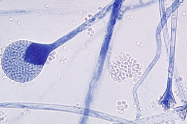 Hongo negro: 5 preguntas sobre la infección en pacientes con covid-19