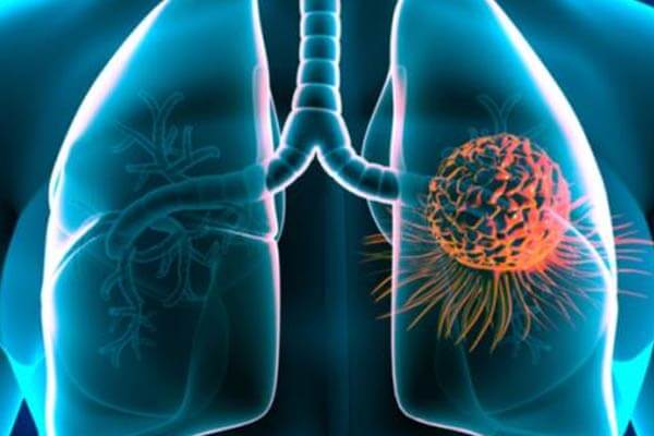 Avances médicos: Terapias biológicas dirigidas al cáncer del pulmón