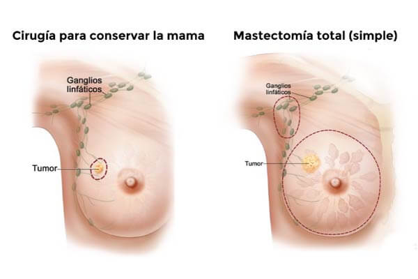 El tipo de cirugía elegido para el cáncer de seno (mama) podría afectar la calidad de vida de las sobrevivientes jóvenes